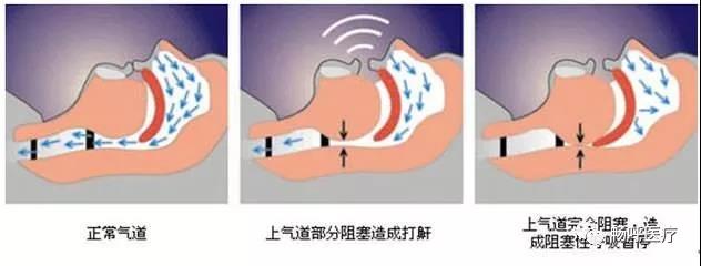 我國(guó)3000萬(wàn)高血壓患者都有這毛??！你知道嗎？